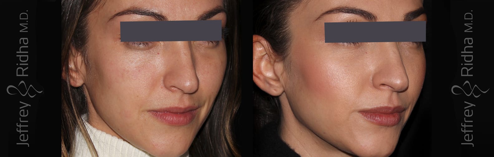 Injectables Before and After - Case 7