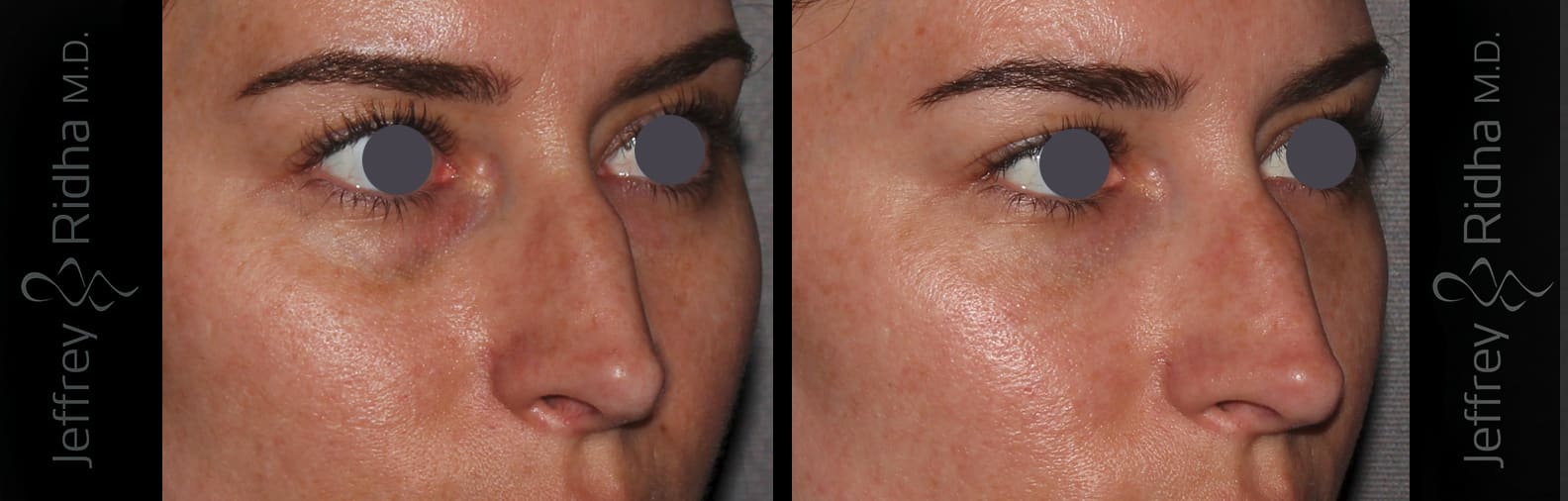 Injectables Before and After - Case 8