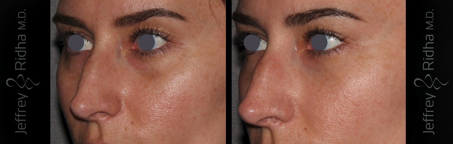Injectables Before and After - Case 8