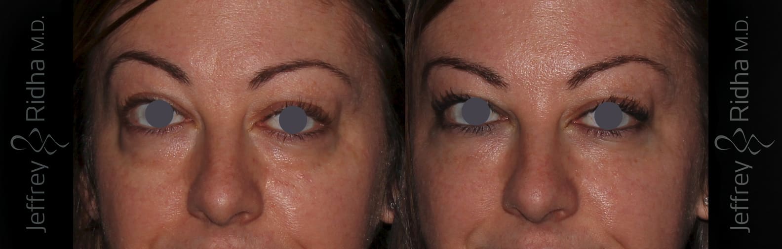 Injectables Before and After - Case 9