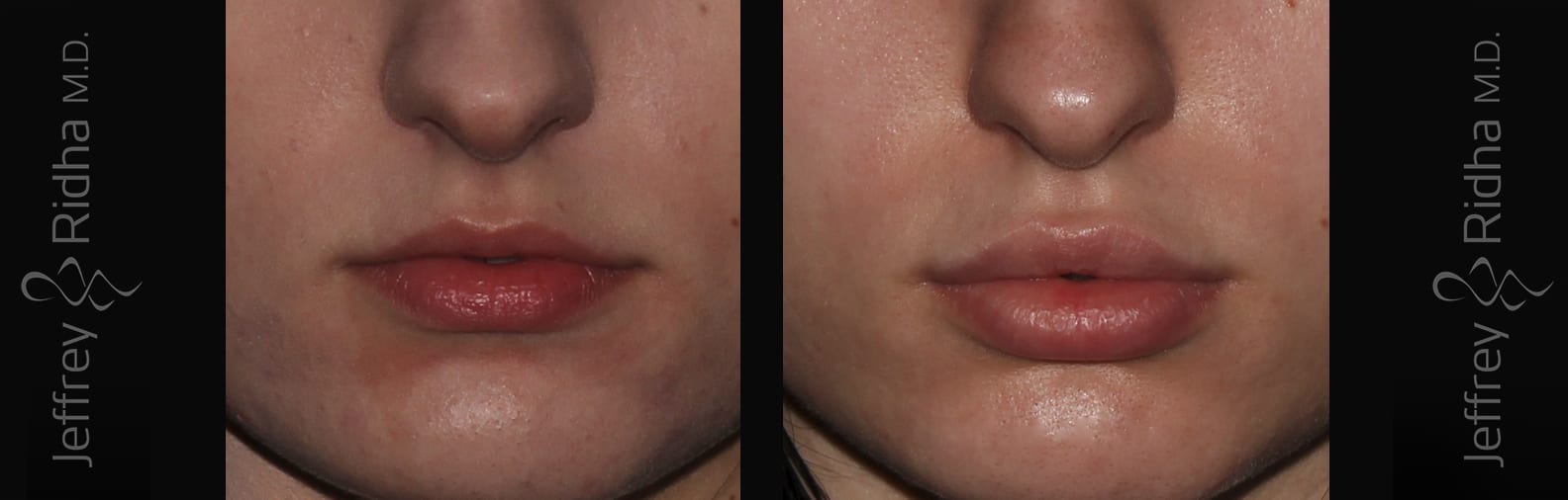 Injectables Before and After - Case 11