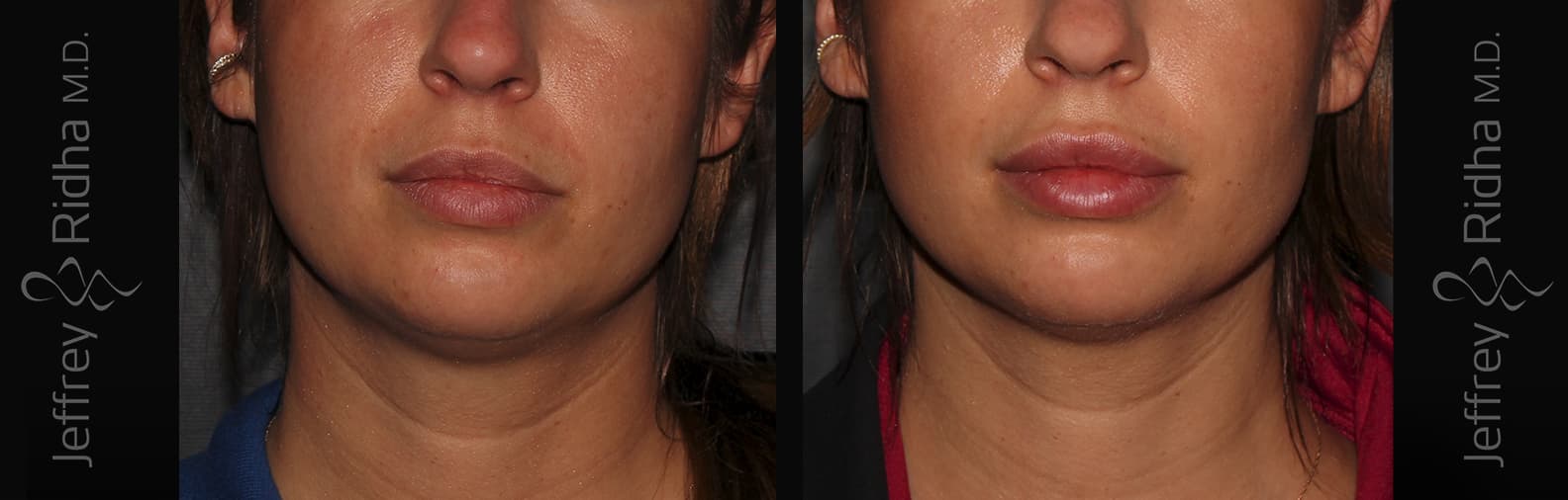 Injectables Before and After - Case 12