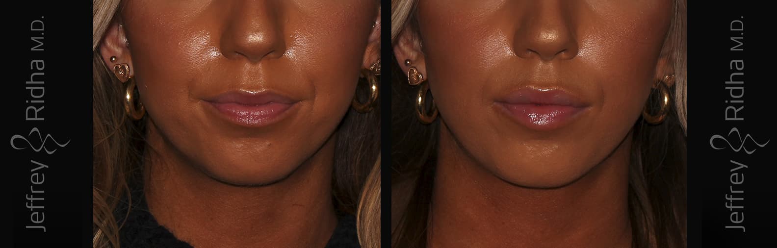 Injectables Before and After - Case 13