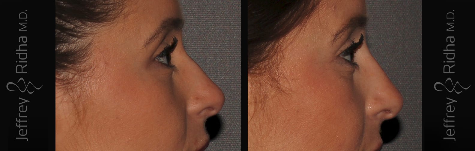 Non-Surgical Rhinoplasty Before and After - Case 1