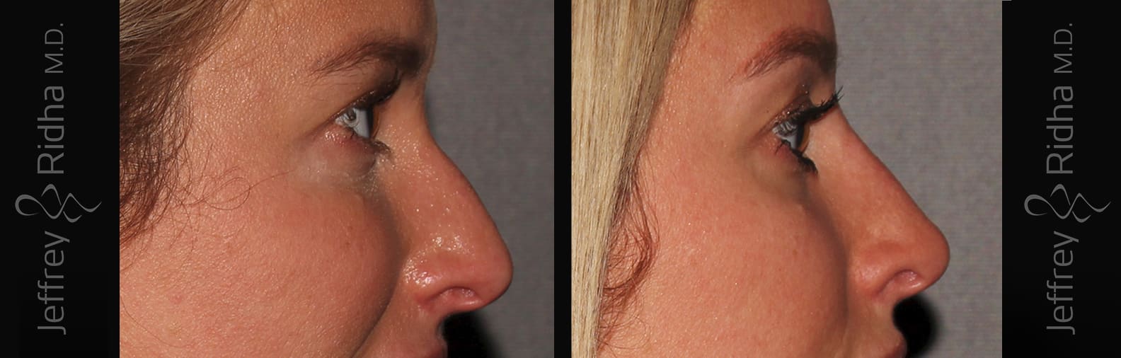 Non-Surgical Rhinoplasty Before and After - Case 2