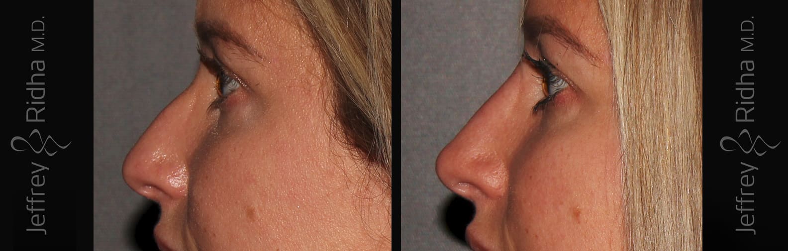 Non-Surgical Rhinoplasty Before and After - Case 2