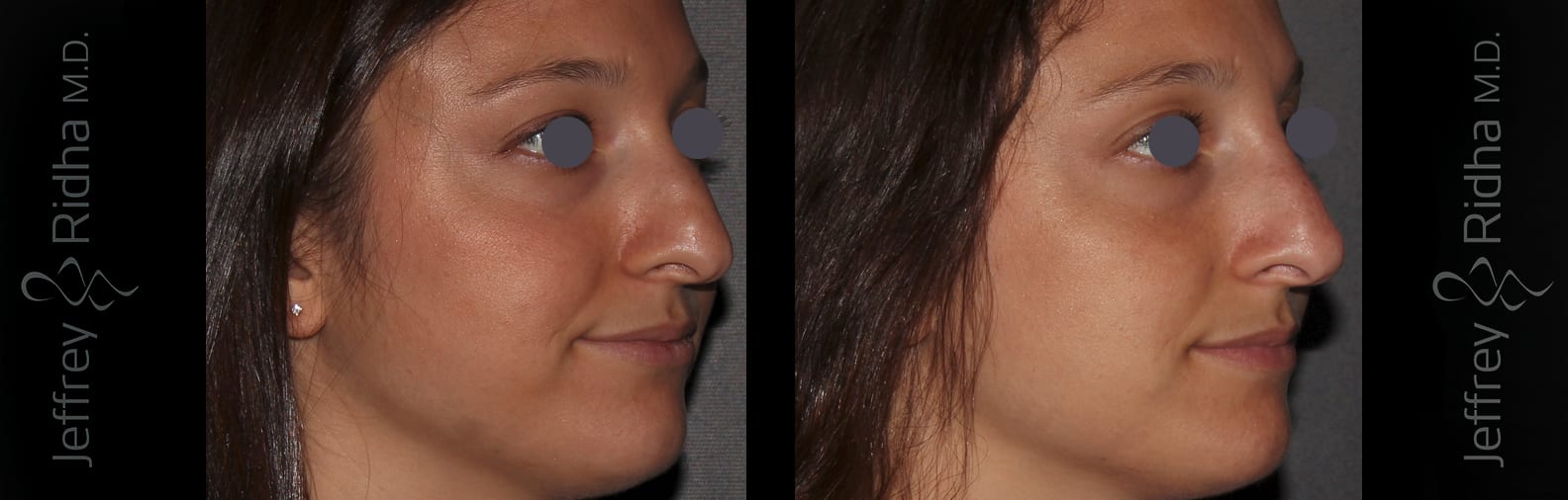 Non-Surgical Rhinoplasty Before and After - Case 3