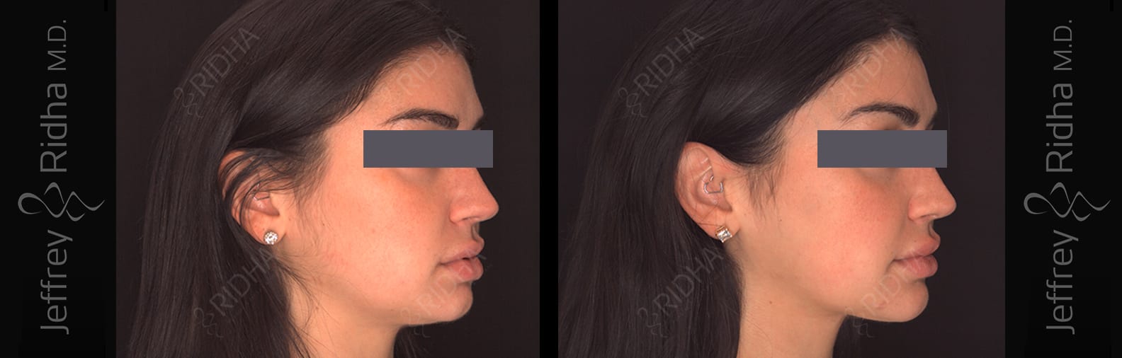 Renuvion Before and After - Case 1