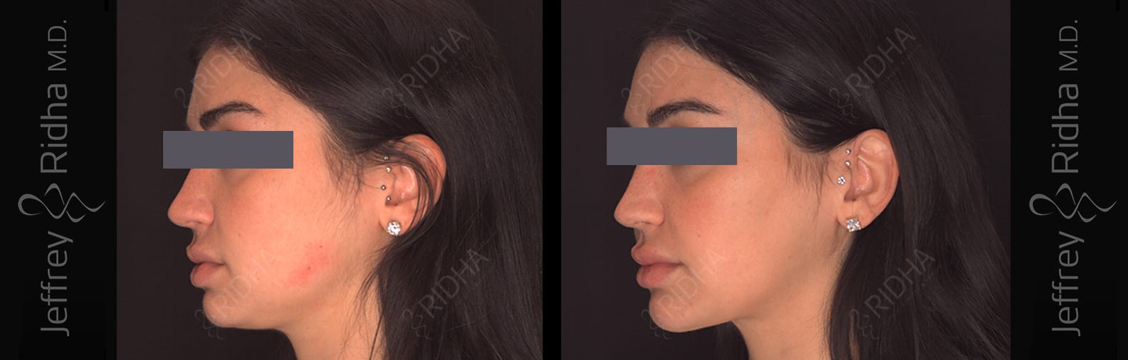 Renuvion Before and After - Case 1