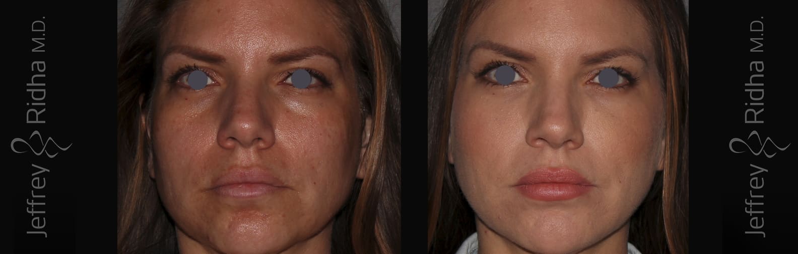 Tear Trough Filler Before and After - Case 4