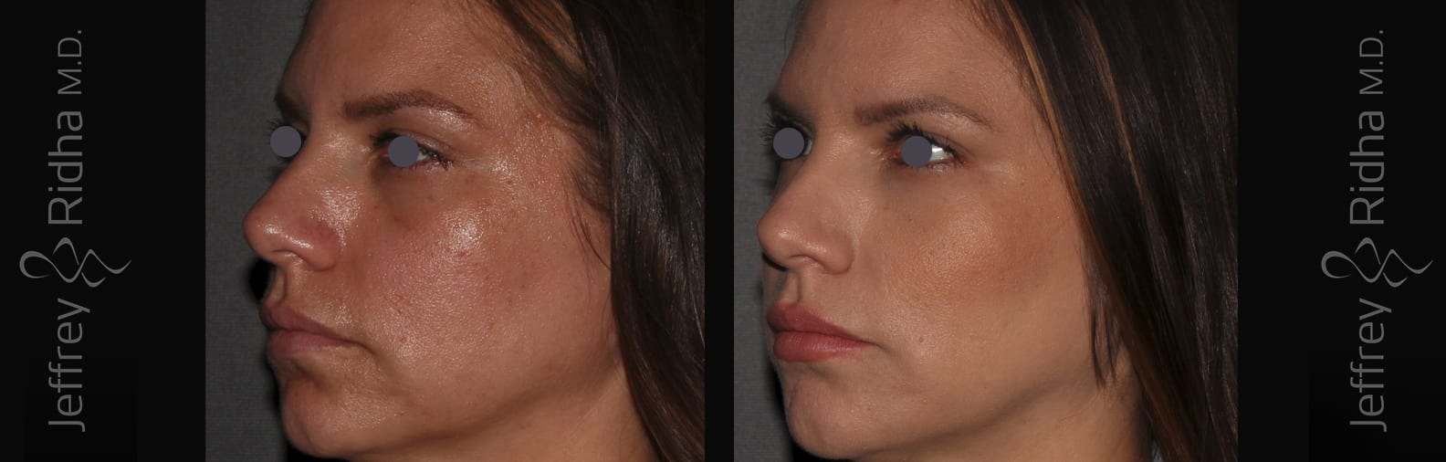 Tear Trough Filler Before and After - Case 4