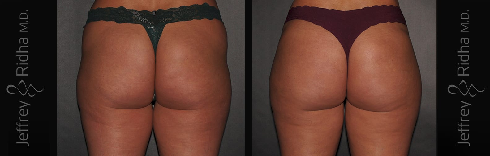 Brazilian Butt Lift Before and After - Case 1