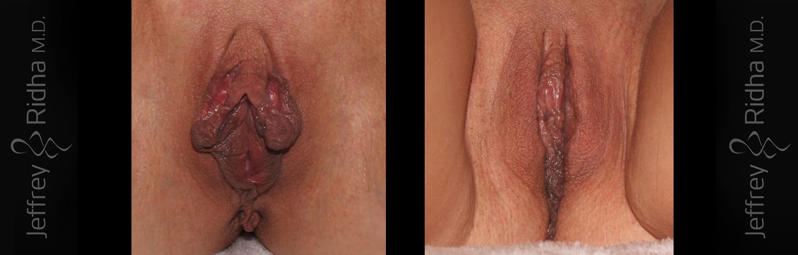 Labiaplasty Before and After - Case 2