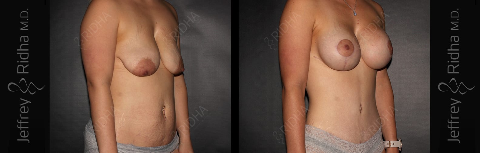 Mommy Makeover Before and After - Case 4