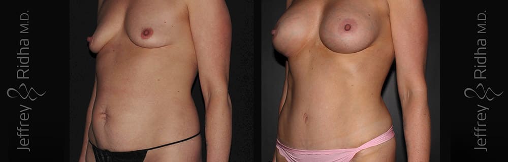 Mommy Makeover Before and After - Case 15