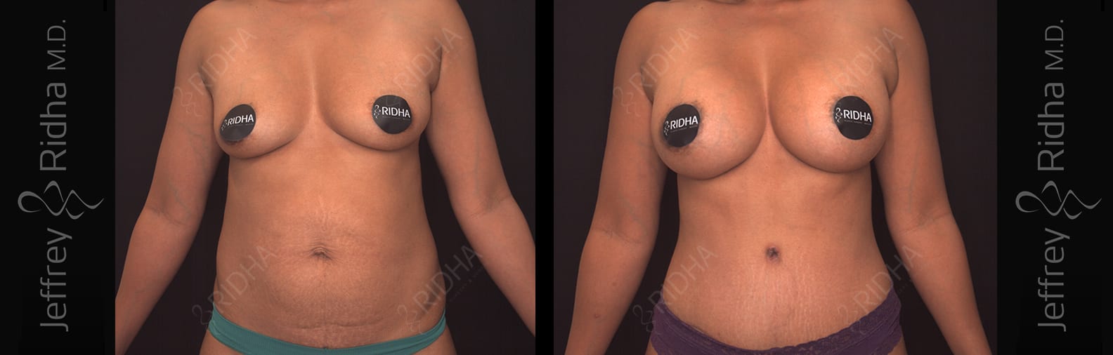 Breast Augmentation Before and After - Case 1