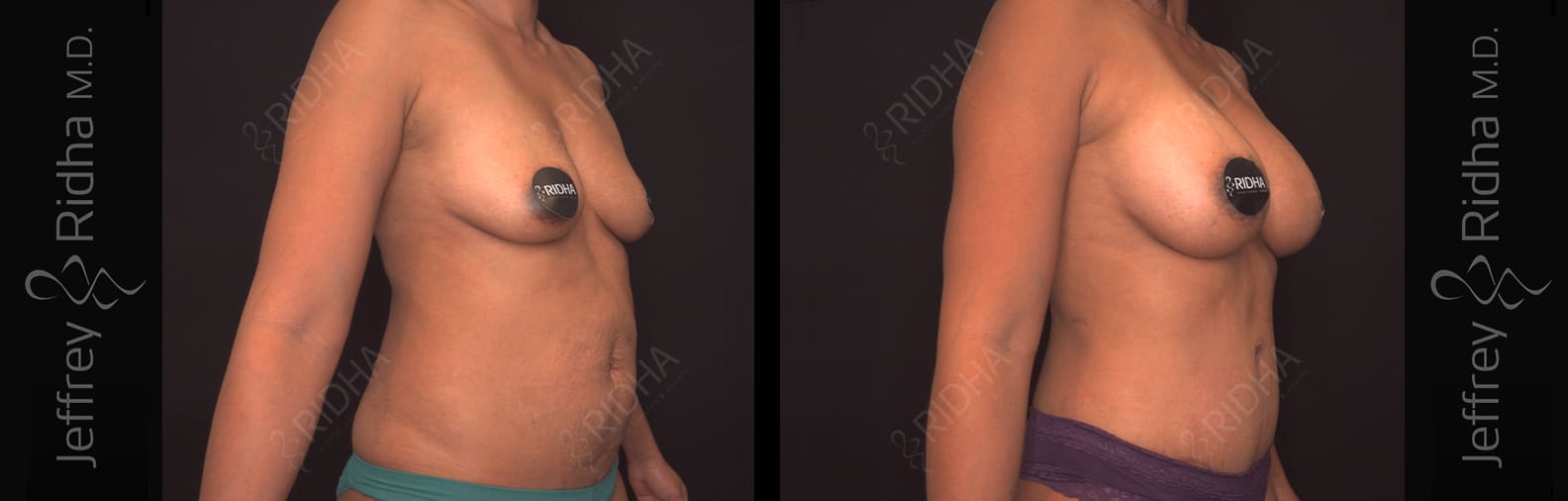 Breast Augmentation Before and After - Case 1