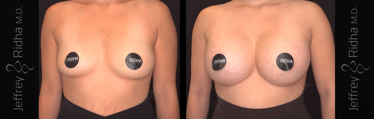 Breast Augmentation Before and After - Case 2