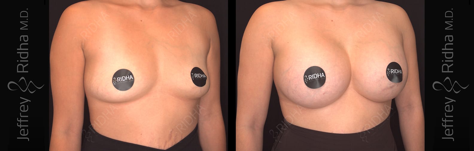 Breast Augmentation Before and After - Case 2