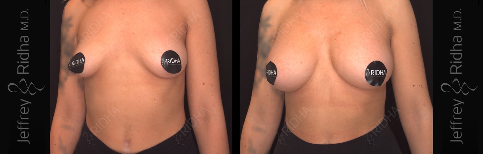 Breast Augmentation Before and After - Case 3