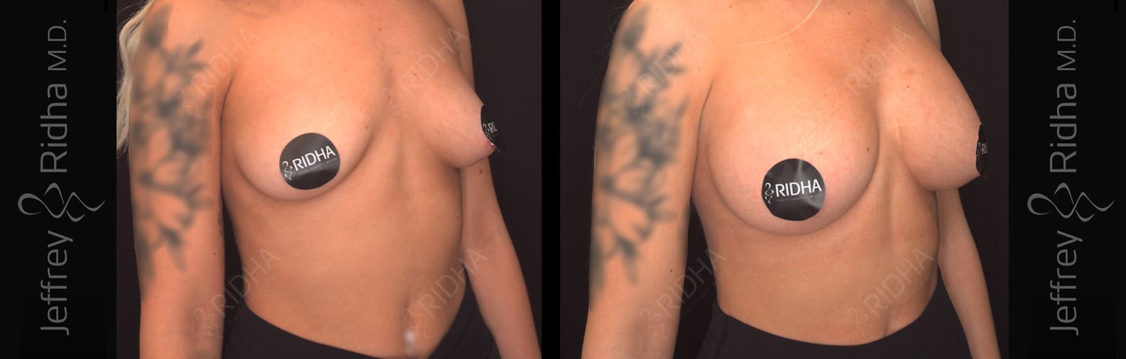 Breast Augmentation Before and After - Case 3