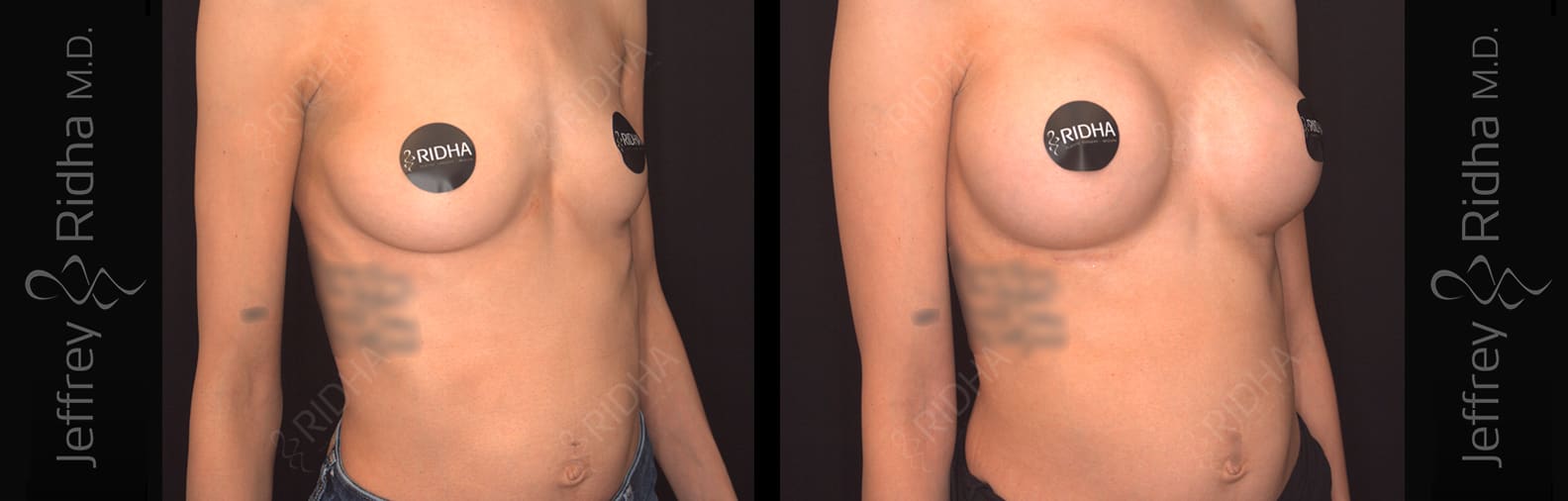 Breast Augmentation Before and After - Case 5