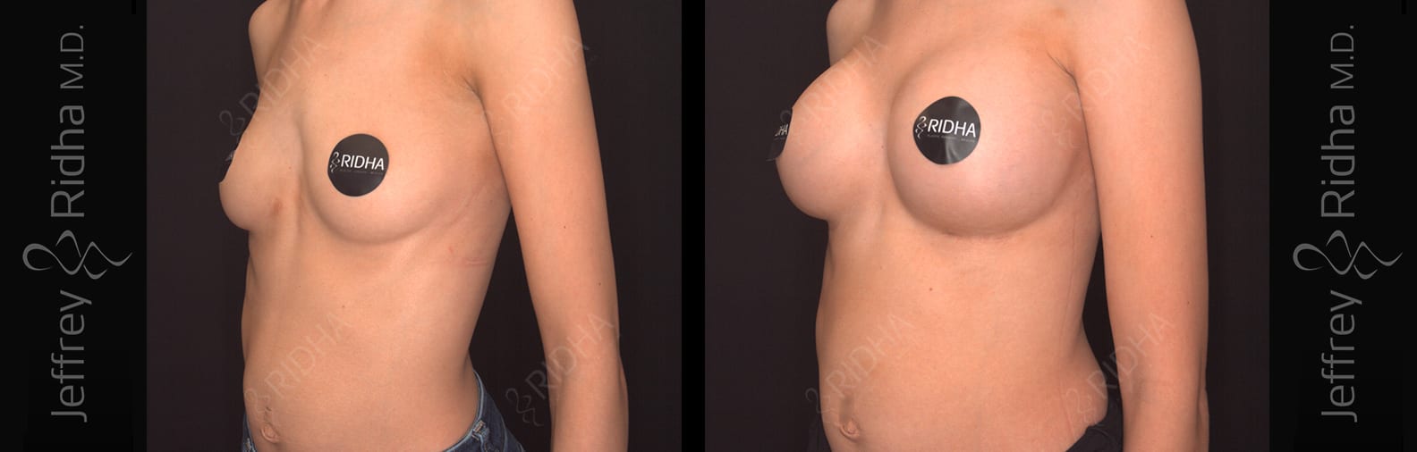 Breast Augmentation Before and After - Case 5
