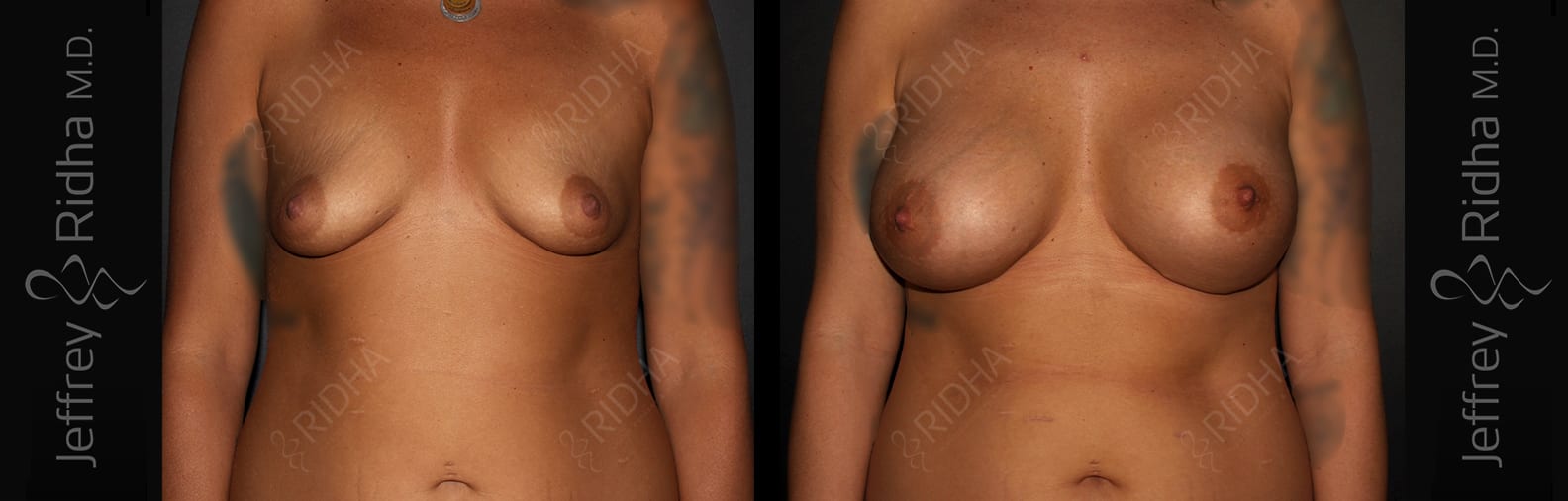 Breast Augmentation Before and After - Case 6