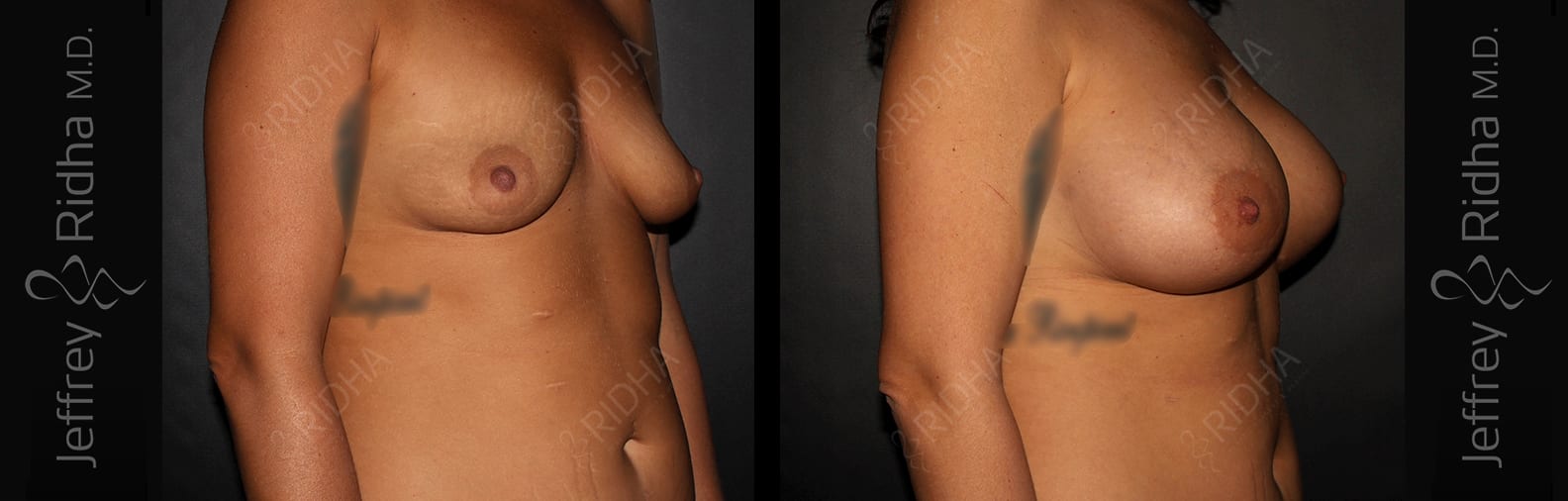 Breast Augmentation Before and After - Case 6