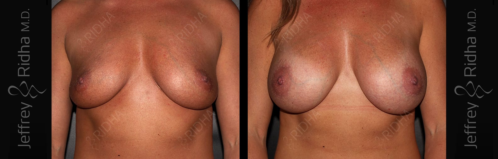 Breast Augmentation Before and After - Case 7