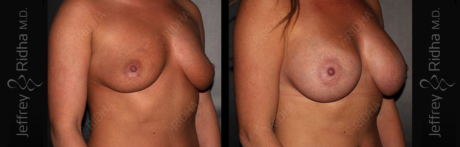Breast Augmentation Before and After - Case 7
