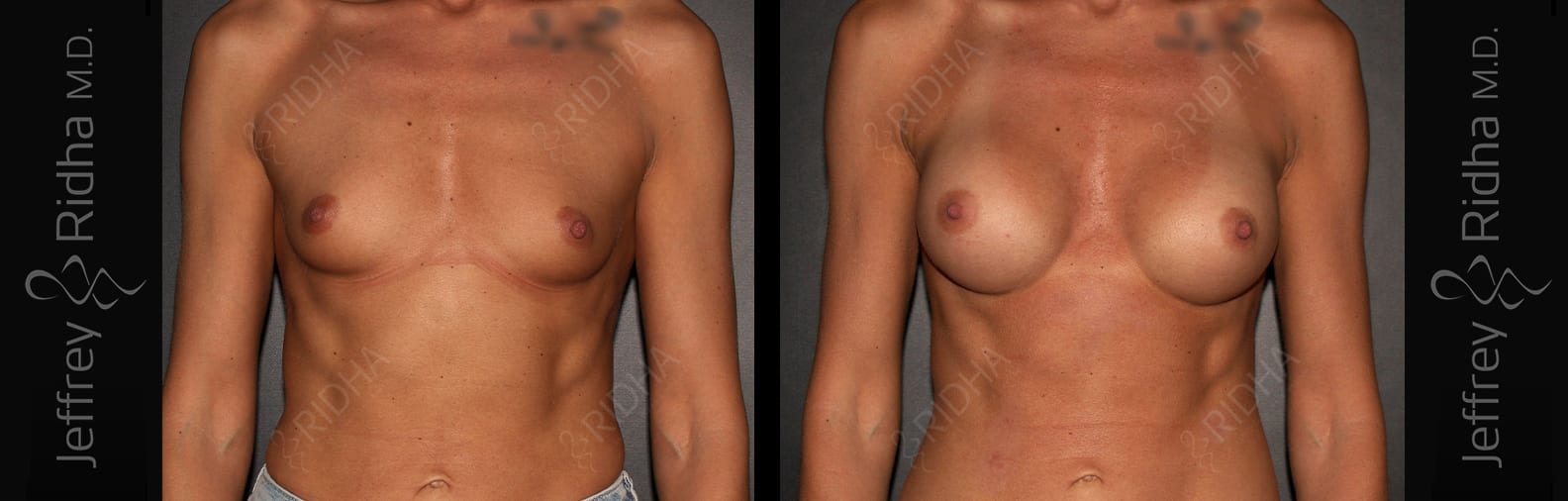 Breast Augmentation Before and After - Case 10
