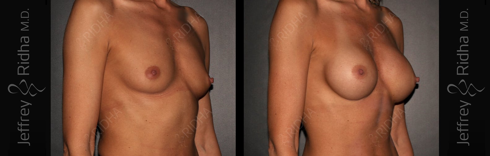 Breast Augmentation Before and After - Case 10
