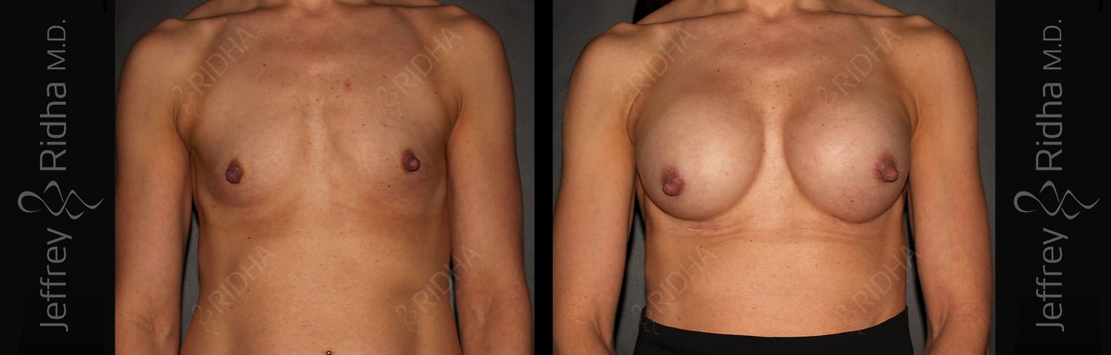 Breast Augmentation Before and After - Case 11