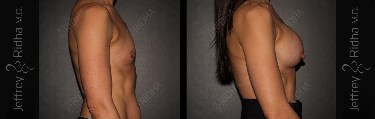 Breast Augmentation Before and After - Case 11