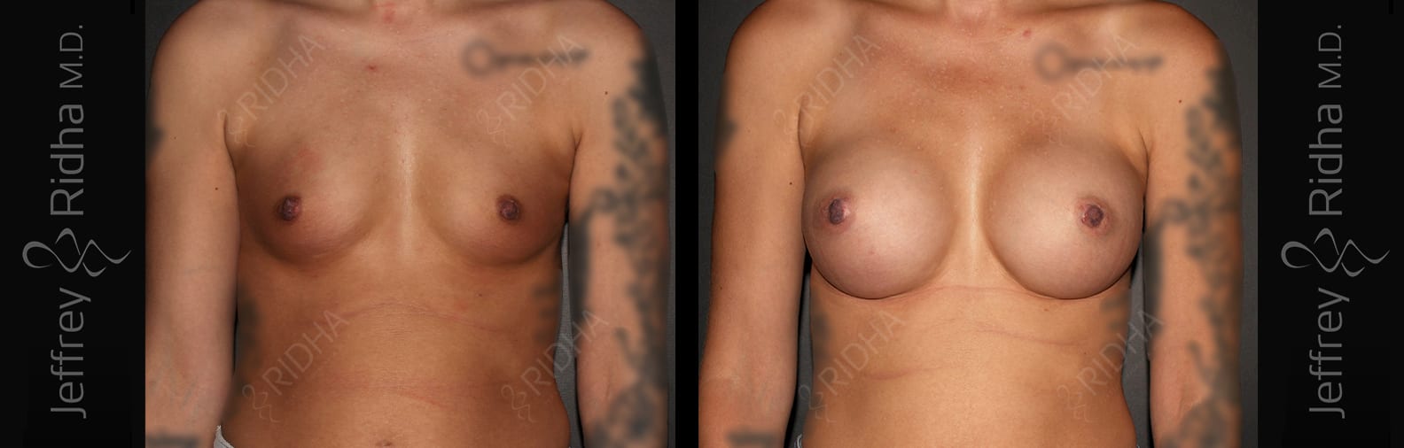 Breast Augmentation Before and After - Case 12