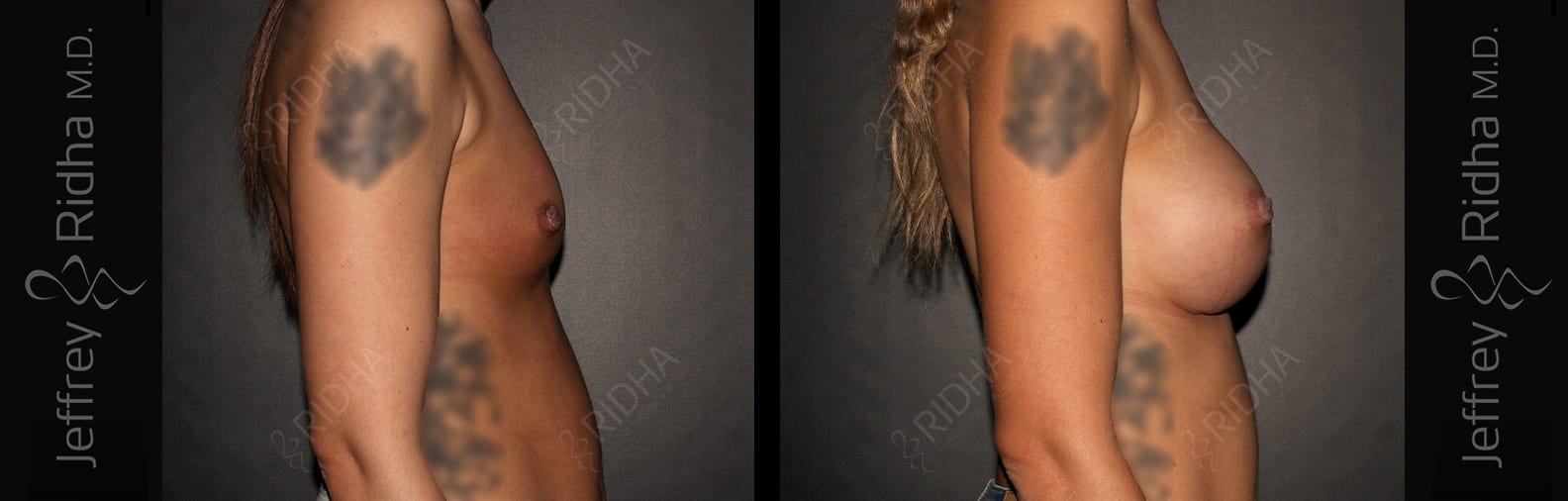 Breast Augmentation Before and After - Case 12