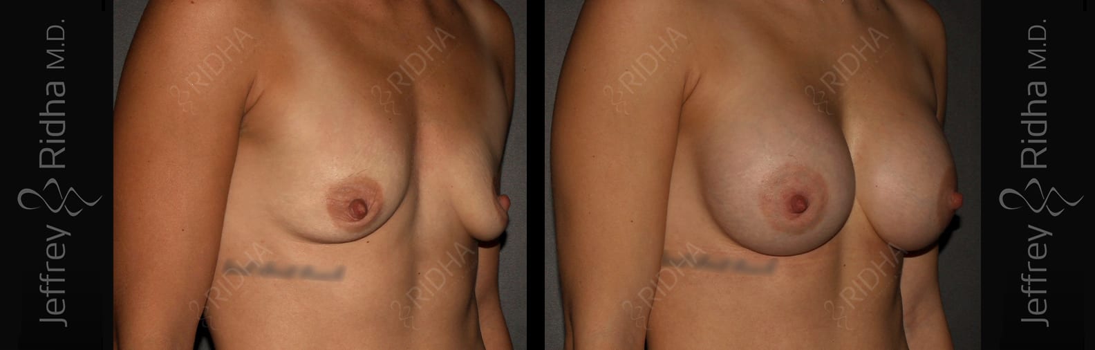 Breast Augmentation Before and After - Case 13