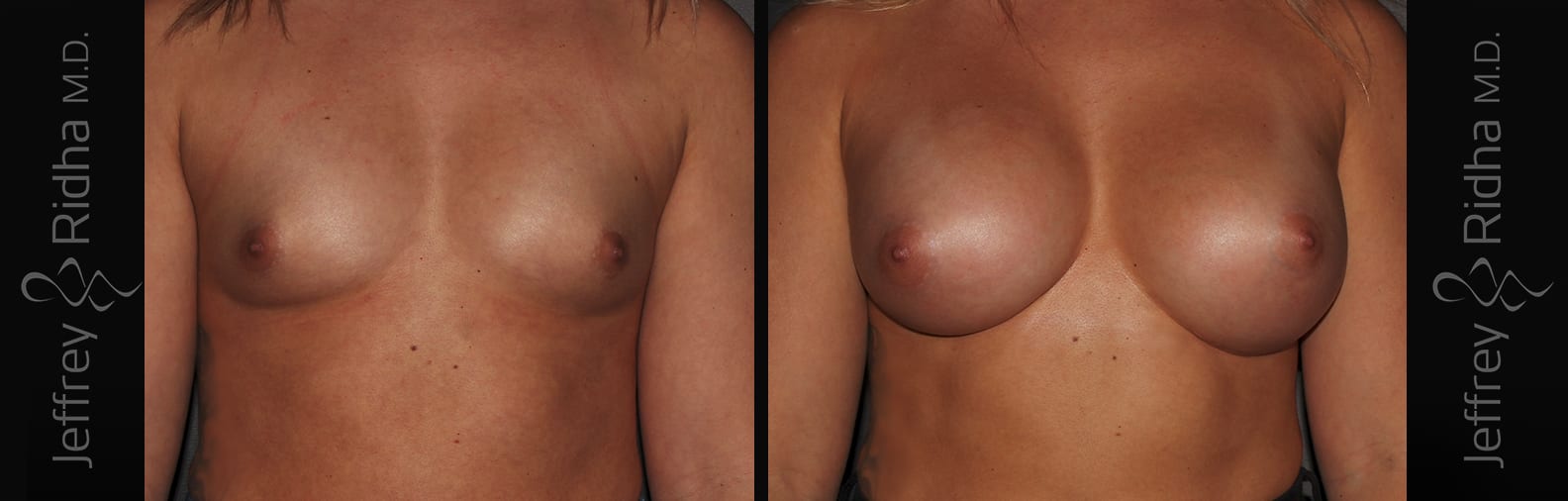Breast Augmentation Before and After - Case 14