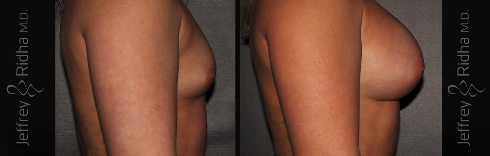 Breast Augmentation Before and After - Case 14