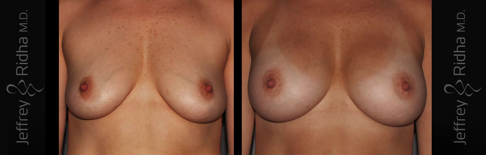 Breast Augmentation Before and After - Case 15