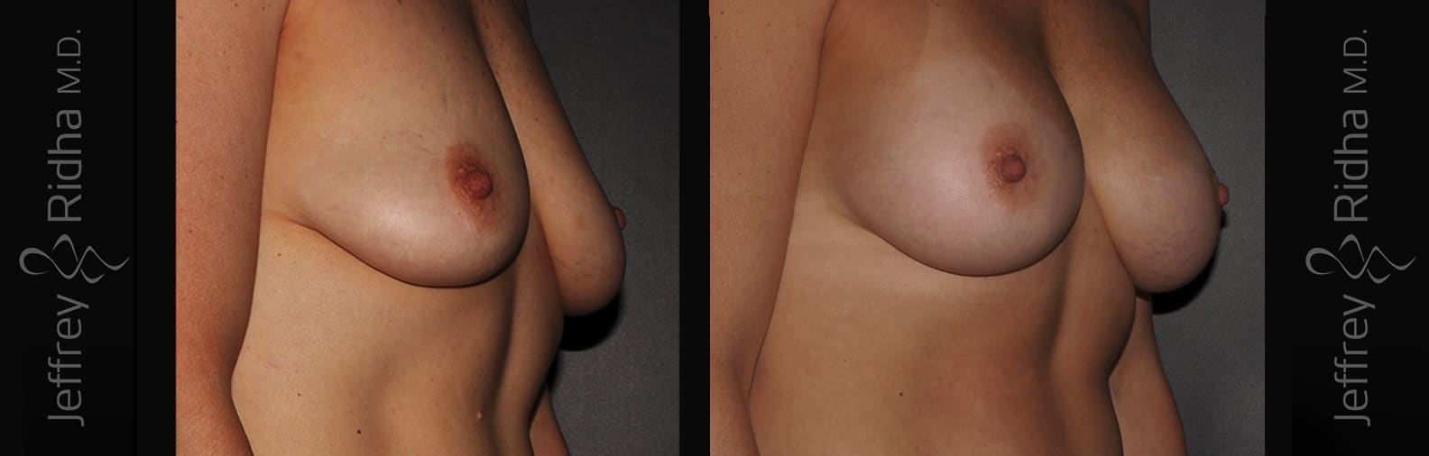 Breast Augmentation Before and After - Case 15