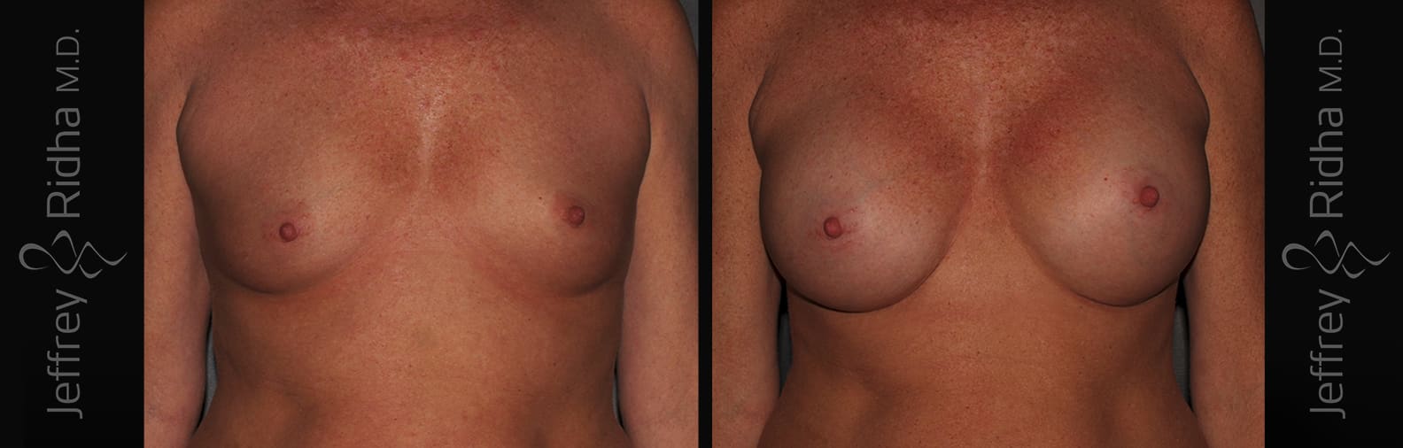 Breast Augmentation Before and After - Case 16