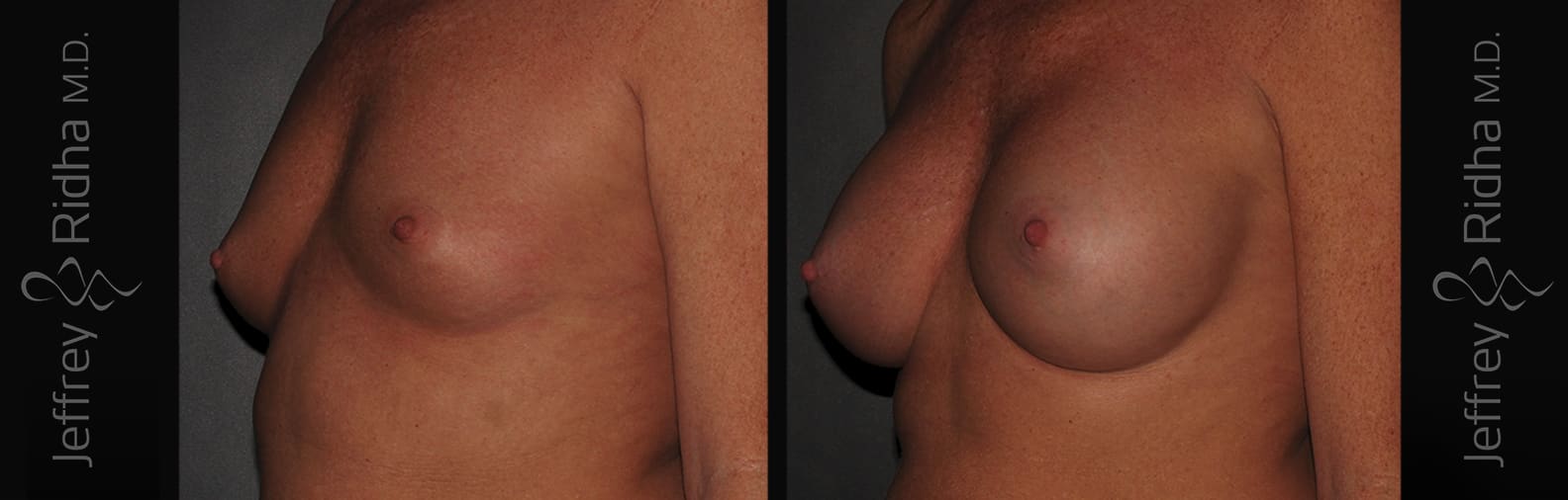 Breast Augmentation Before and After - Case 16
