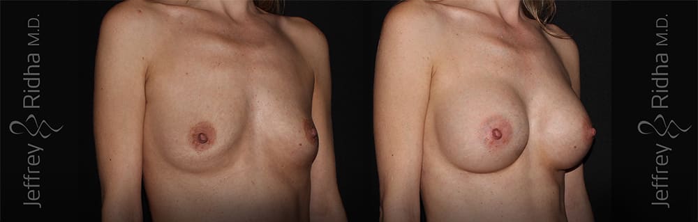Breast Augmentation Before and After - Case 19