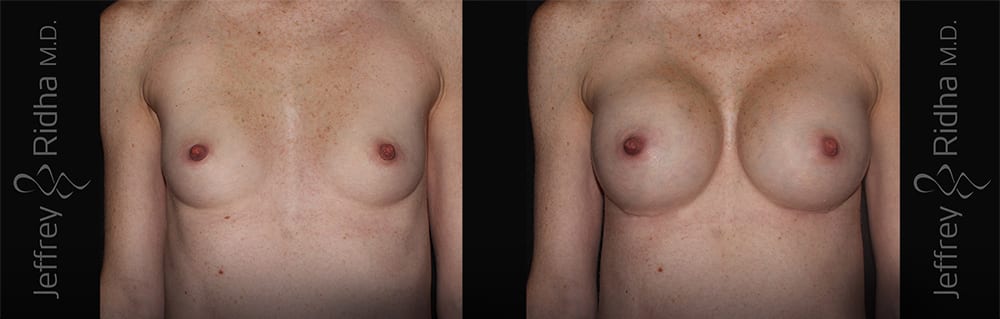Breast Augmentation Before and After - Case 20