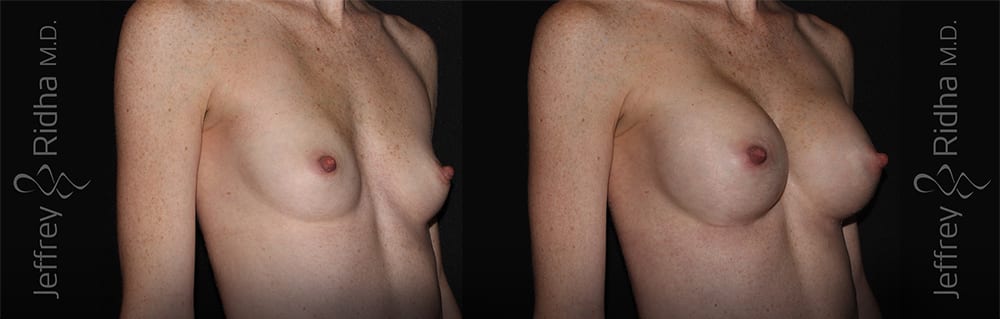 Breast Augmentation Before and After - Case 20