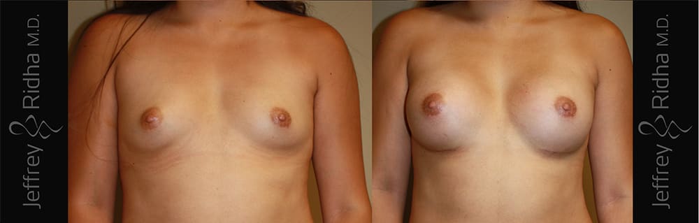 Breast Augmentation Before and After - Case 21