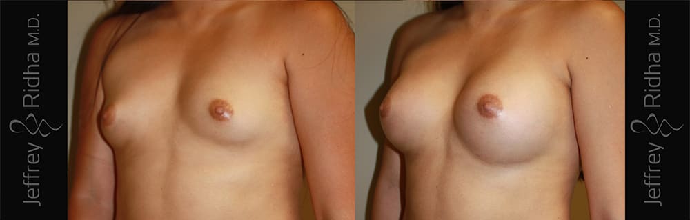 Breast Augmentation Before and After - Case 21