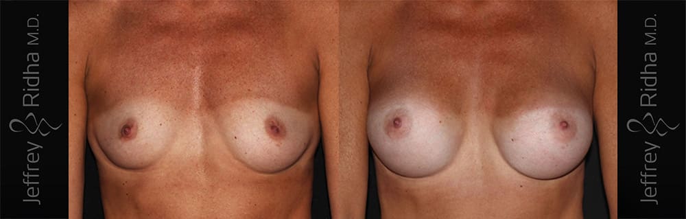 Breast Augmentation Before and After - Case 22